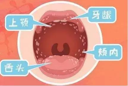 宝宝嘴里的“奶块”擦不掉！竟然是感染了这种真菌！