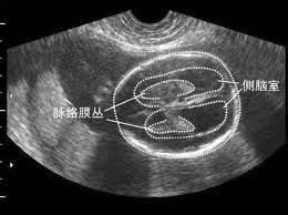 孕期侧脑室增宽就是异常？孕妈了解后更放心了