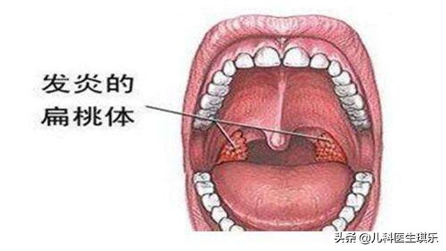 为什么宝宝的扁桃体炎总是反复发作？