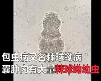 4岁娃腹中抽出2斤寄生虫液！屁股痒、肚痛，要当心！