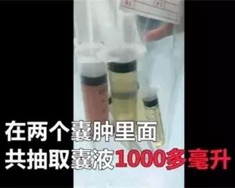 4岁娃腹中抽出2斤寄生虫液！屁股痒、肚痛，要当心！
