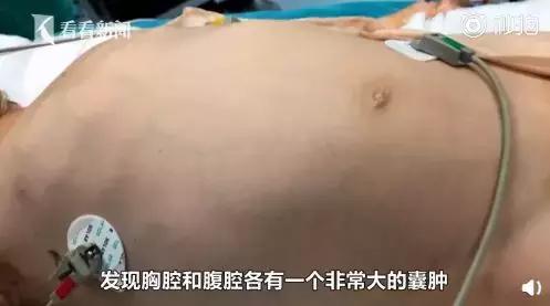 4岁娃腹中抽出2斤寄生虫液！屁股痒、肚痛，要当心！