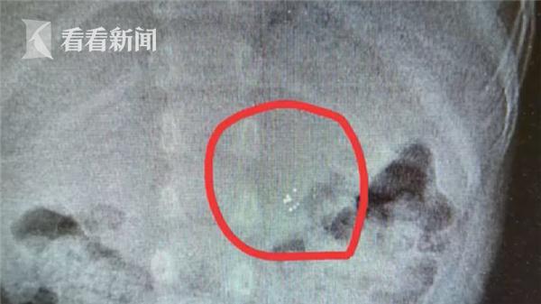 3岁宝宝误将温度计当玩具 咬碎后吞下了水银……