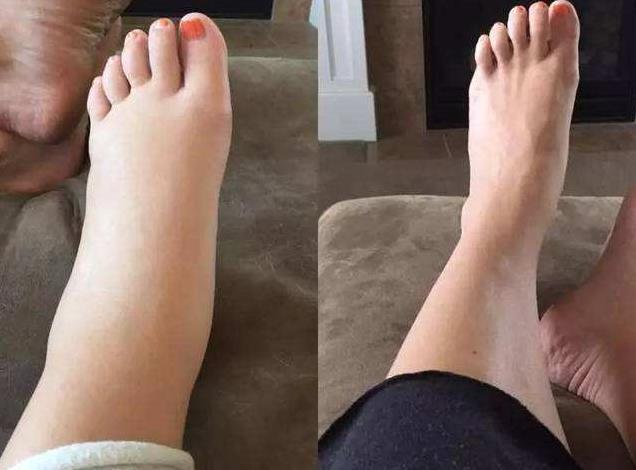 进入孕晚期后，若孕妇出现了水肿的情况，你可以这样应对！