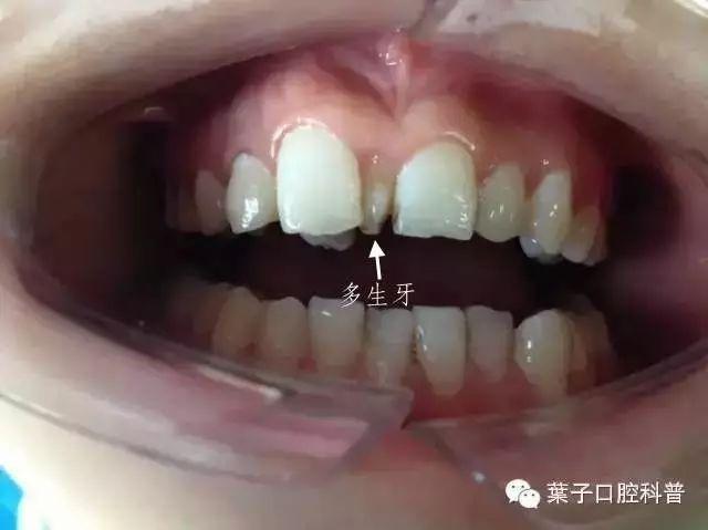 孩子有多生的牙齿,需要拔掉吗?#葉子口腔科普#
