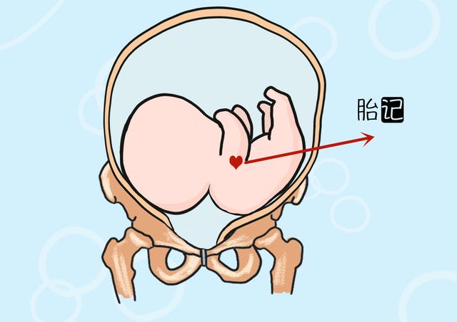 新生儿胎记和孕期习惯有啥关系？引发胎记的几个母体因素，要避免