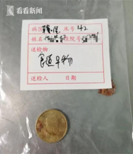 1岁男童接连呕吐多日 X光片显示竟有一圆形阴影