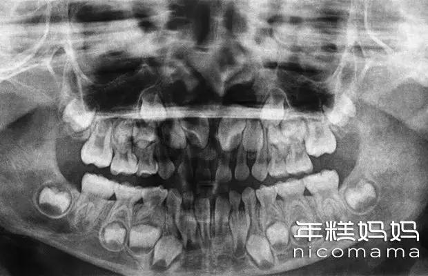 6岁前牙齿太整齐，真不是好事！