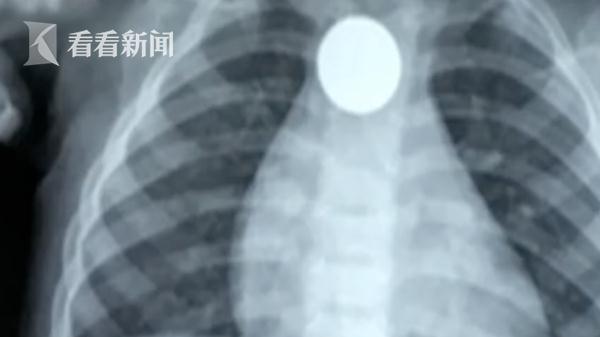 1岁男童接连呕吐多日 X光片显示竟有一圆形阴影