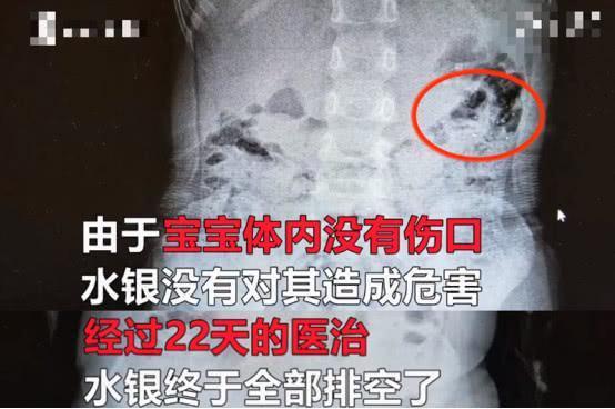 3岁宝宝咬碎温度计误吞水银，医生：喝牛奶解毒是片面的