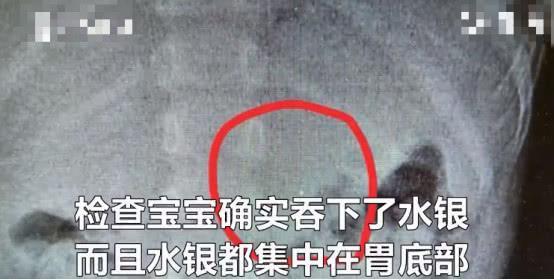 3岁宝宝咬碎温度计误吞水银，医生：喝牛奶解毒是片面的