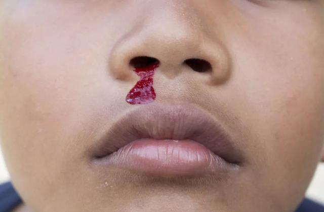 小孩流鼻血怎么办？三妙招有效止血！