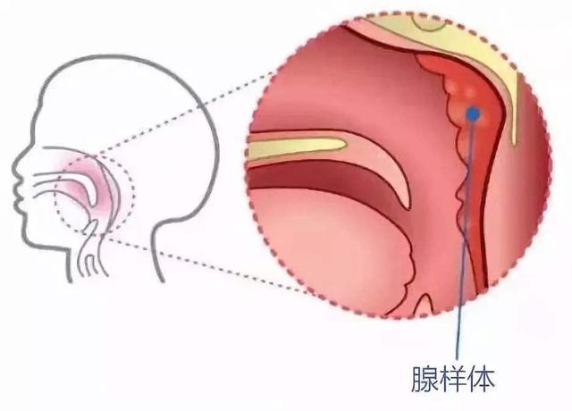 孩子打呼噜代表睡得香？别逗了，严重时影响孩子智力和颜值