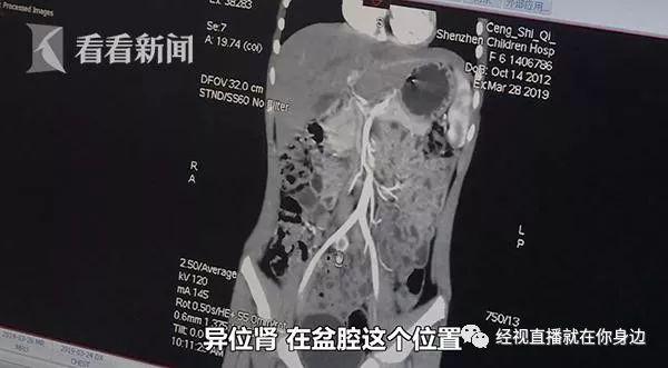 6岁小女孩尿裤子4年，一查发现右肾竟然“不见了”！？