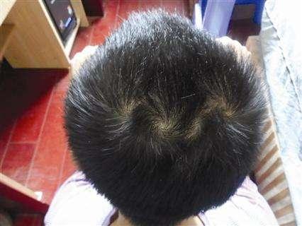 孩子头上“旋”越多越难管教？“旋”的个数与孩子性格有何联系
