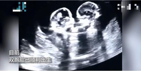 准妈做孕检时意外看到双胞胎在打架，网友：争宠要从肚子里抓起