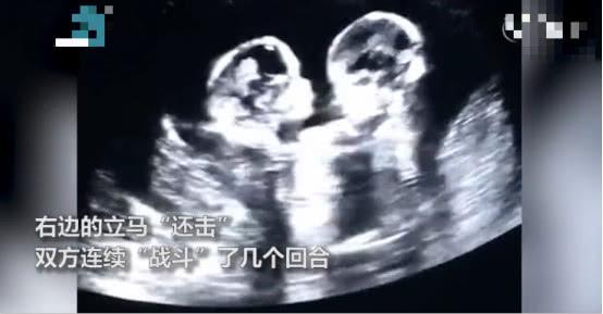 准妈做孕检时意外看到双胞胎在打架，网友：争宠要从肚子里抓起
