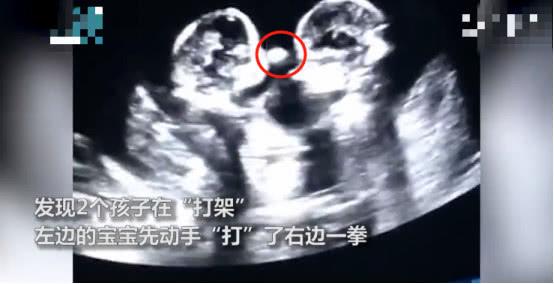 准妈做孕检时意外看到双胞胎在打架，网友：争宠要从肚子里抓起