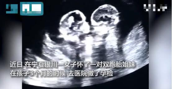 准妈做孕检时意外看到双胞胎在打架，网友：争宠要从肚子里抓起