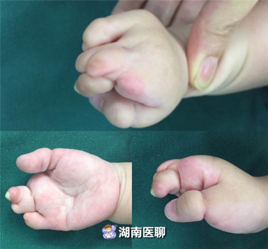 8月大宝宝右手畸形没五指像个“小肉桃”？打娘胎带来的罕见病！