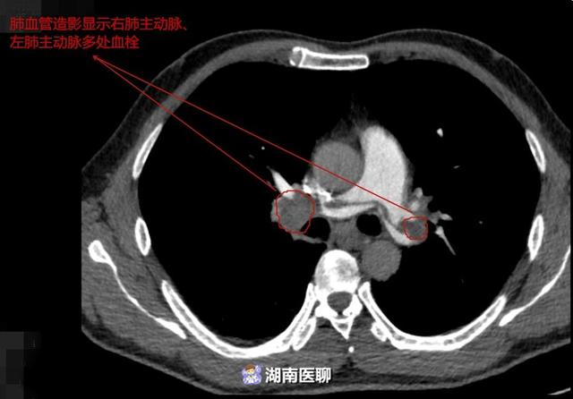 二孩妈妈咳嗽气促，以为是产后虚弱，坐完月子才知是肺栓塞？