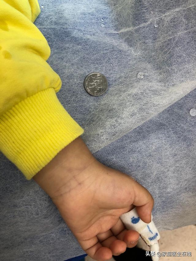 危机：2岁女童误吞硬币！家长需学的急救常识，医生说给你听