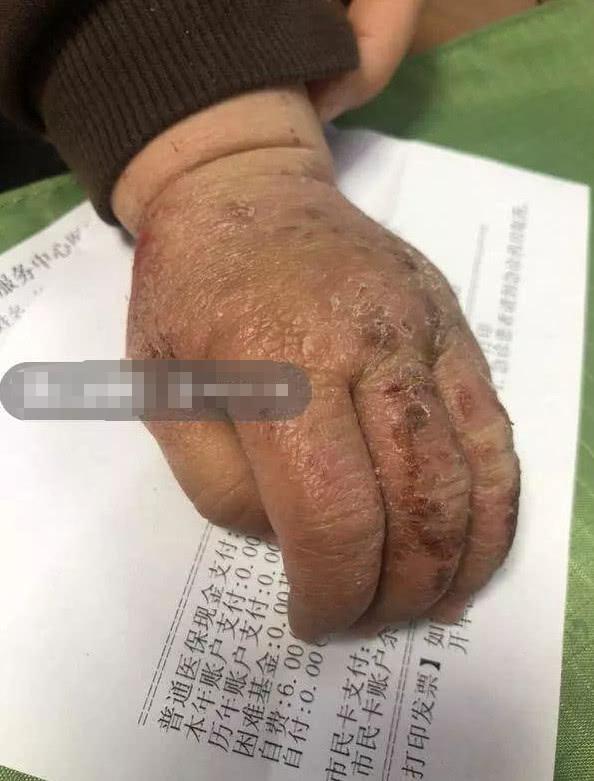 1岁婴儿长着80岁老人的手，医生称这种情况并不少见