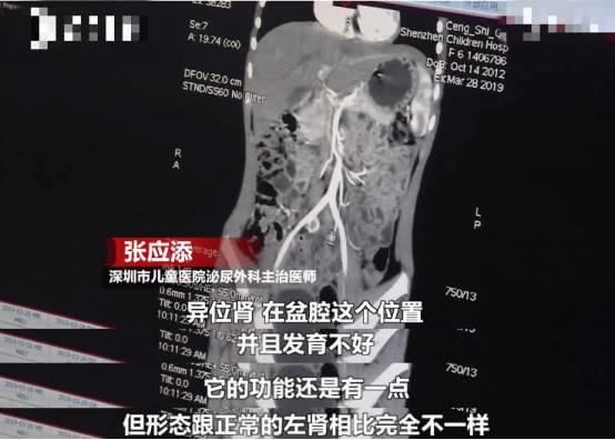 6岁女孩从两岁起就尿裤子，去医院检查后发现右肾“不见”了