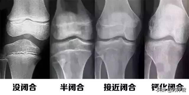 儿科医生点名的3种影响长高的食物，你还在给孩子吃吗？
