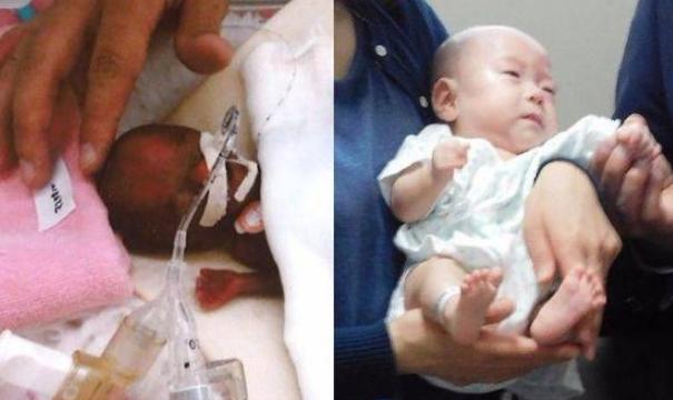 奇迹！日本全世界最小男婴现在健康长大了，近期将准备出院！