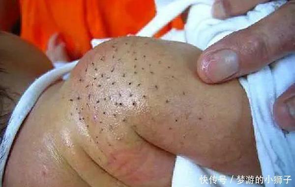 宝宝身上长了黑色毛刺，女子徒手拔掉，孩子高烧不止，结果悲剧了