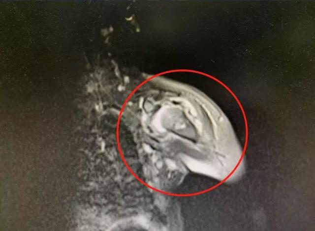 20天大的宝宝，患上骨髓炎、关节炎！医生：细菌入侵“吞噬”骨质
