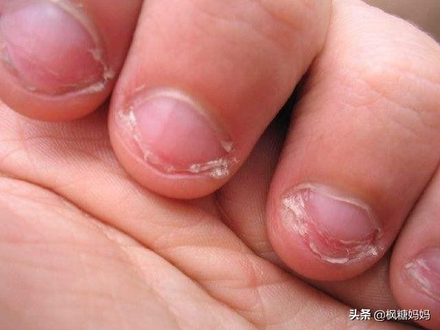 如果发现孩子咬指甲，第一时间的处理很重要，别让他咬到40岁