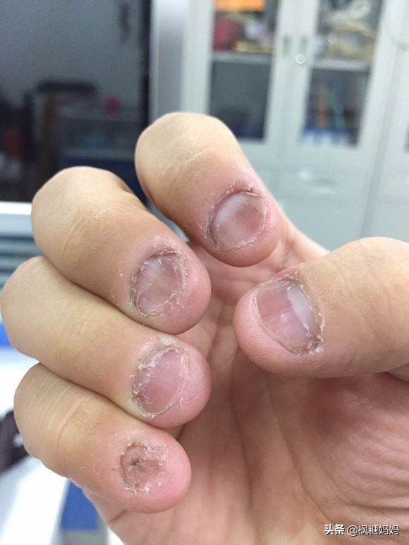 如果发现孩子咬指甲，第一时间的处理很重要，别让他咬到40岁