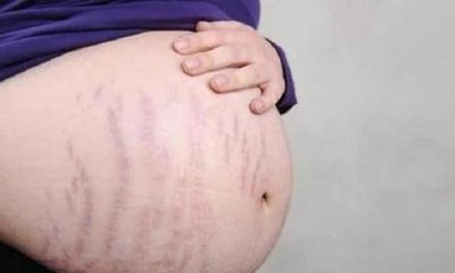 这4种孕妈很容易长妊娠纹，只有第四个是例外，能自己控制！