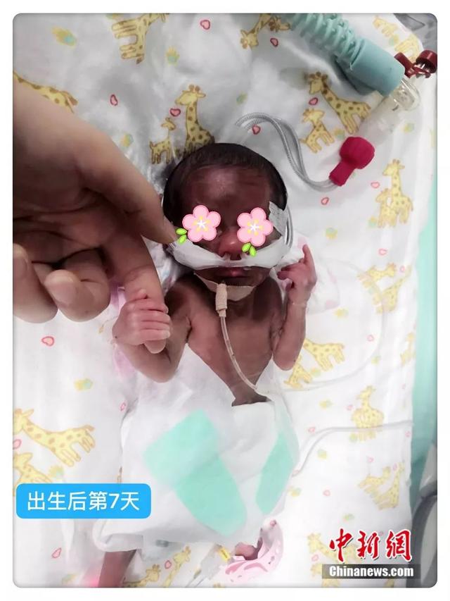 这是一场与生命的赛跑，幸运的是宝宝她赢了！泪目……