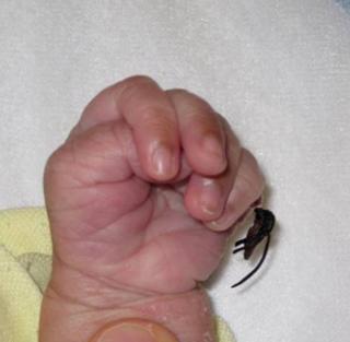 老太太拿头发丝勒掉宝宝多指，简单举动背后的风险多大你知道吗？