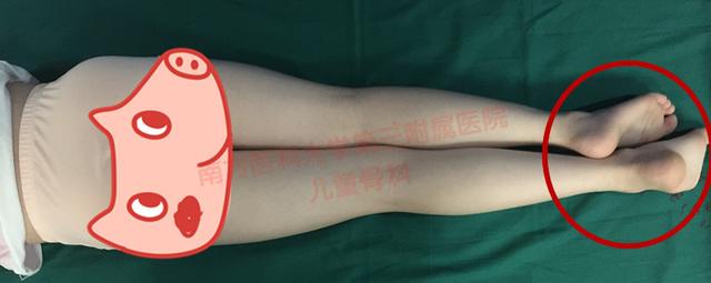 孩子长短腿7.5厘米，先天性髋关节发育不良导致跛行的原因是什么