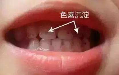 孩子牙齿上的黑斑是什么？看完你就懂了！