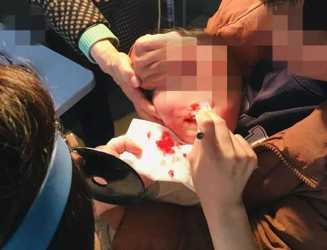 淄博1岁宝宝鼻腔进异物，3天后由小米粒变成“水晶球”