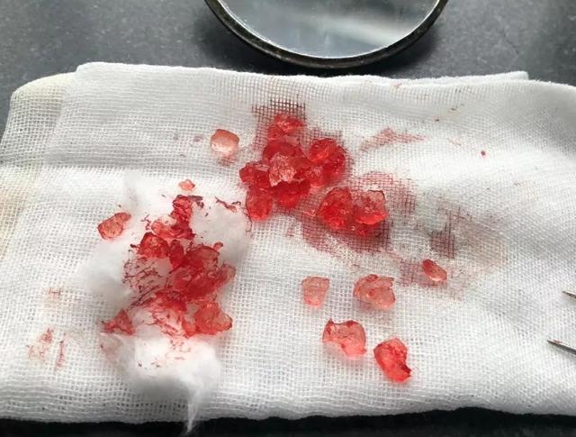 淄博1岁宝宝鼻腔进异物，3天后由小米粒变成“水晶球”