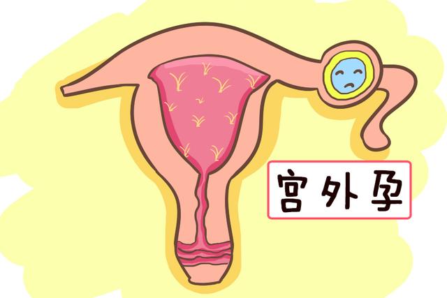 宫外孕和宫内孕是不同的感受，孕妈要了解清楚，正确辨别是关键！