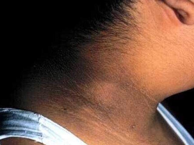 8岁女孩后脖颈发黑洗不掉，去医院检查，医生的话，家长自责