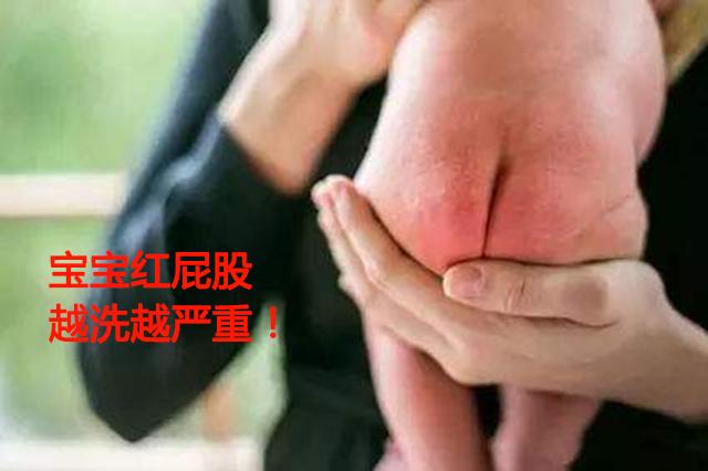 夏季是宝宝红屁股高发季节，勤洗勤擦能预防？那你就大错特错了