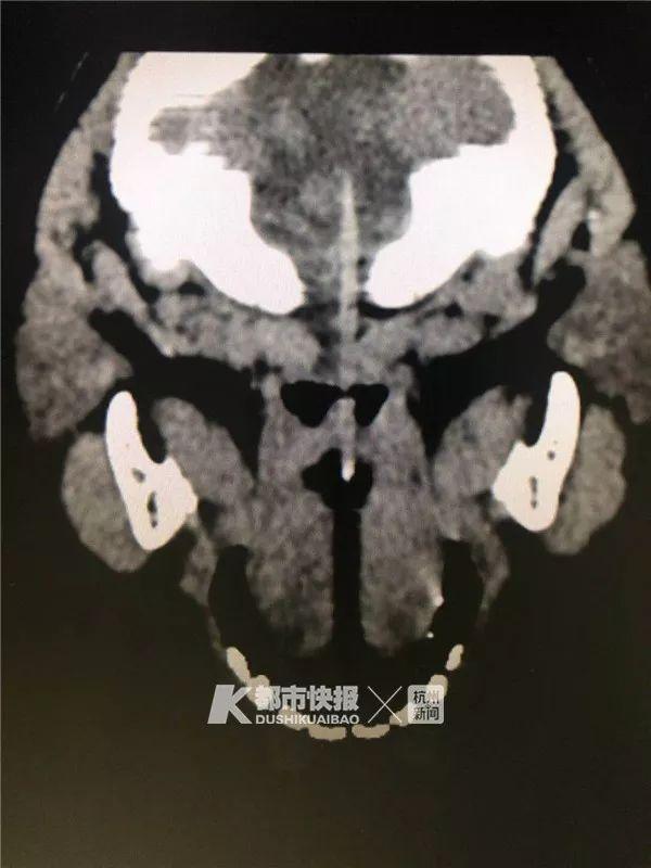 重要提醒！男孩吃烤肠时险些丧命，只因……近期家长更要当心！