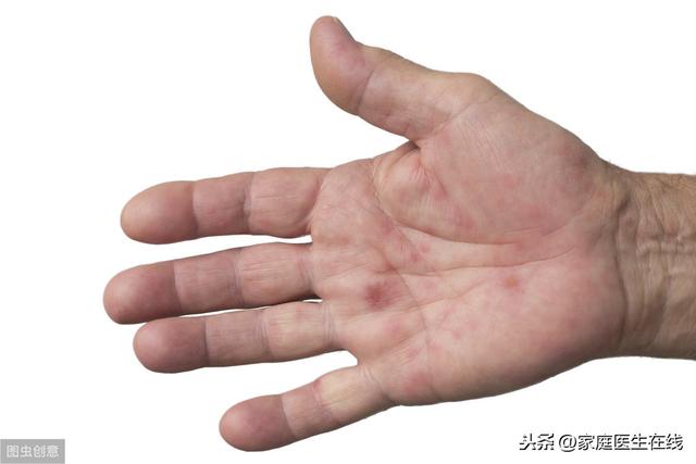 手足口病有哪些初期症状？孩子出现这几个异常，需及时隔离并治疗