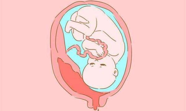 胎盘早剥是怎么回事？识别胎盘早剥，这些危险信号早知道