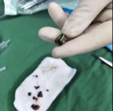 孩子身上发出阵阵臭味，一看这里都坏死了，这辈子都受影响！
