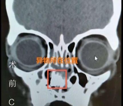 孩子身上发出阵阵臭味，一看这里都坏死了，这辈子都受影响！