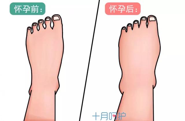 孕期这5种水肿要小心，不注意会影响胎儿发育